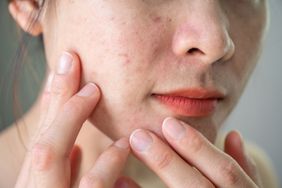 best-ingredients-for-acne-GettyImages-1469751146