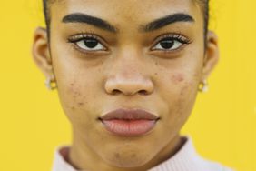 causes-of-acne-GettyImages-1303513779