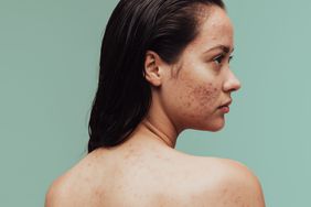 how-to-treat-acne-scars-GettyImages-1326434308
