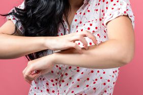 eczema-triggers: woman scratching arm